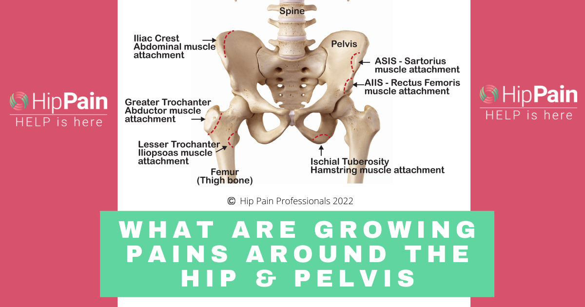 growing pains around the hip and pelvis, apophysitis, avulsion fracture