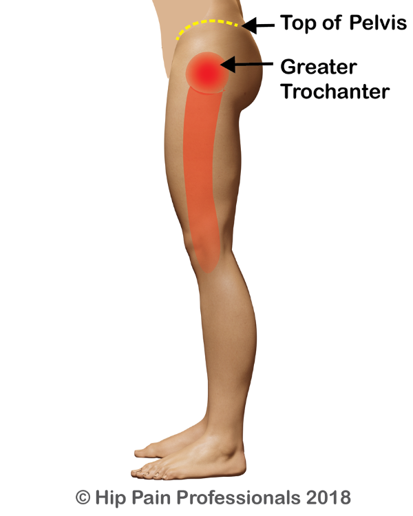area-of-pain-experienced-with-gluteal-tendinopathy